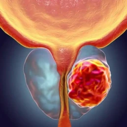 Noviembre: Hablemos De Cáncer De Próstata 8 677442957 224824085 1706X960 Uai